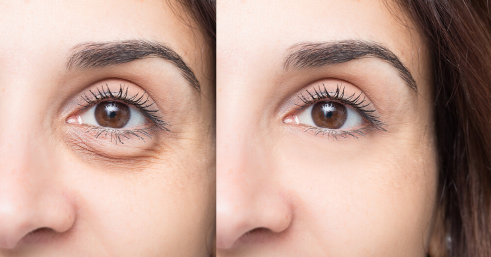 A Complete Guide To Best Under-eye Cream For Dark Circles Dermatologist Recommended